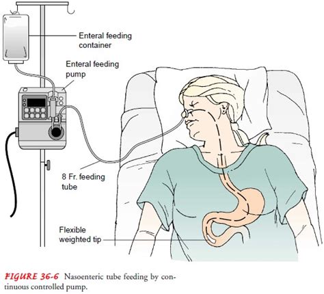 confirm <b>tube</b> placement after the <b>feeding</b> <b>has</b> been. . A nurse is preparing to administer an intermittent tube feeding to a client who has a gastrostomy